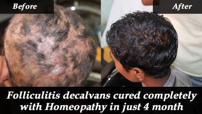 Folliculitis decalvans cured completely with Homeopathy in just 4 month