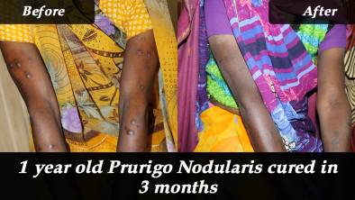  1 year old Prurigo Nodularis cured in 3 months with homeopathy