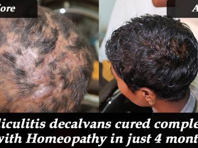 Folliculitis decalvans cured completely with Homeopathy in just 4 month |  Case Study