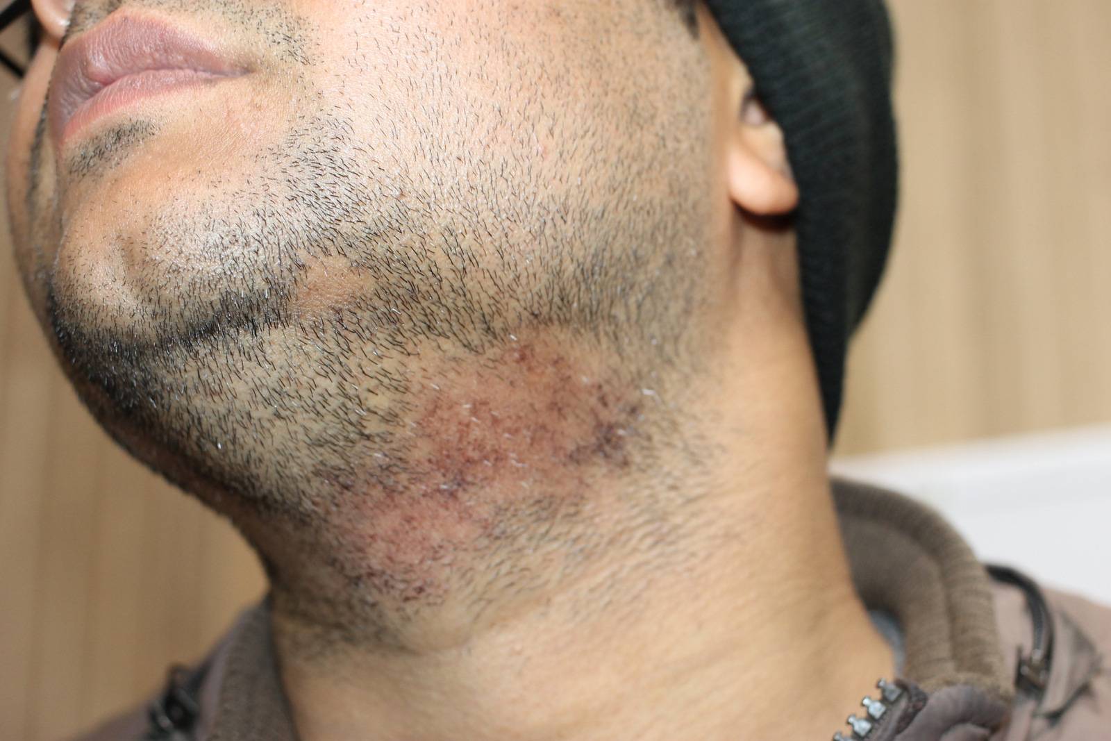 Patchy Hair Loss Of Beard Alopecia Barbae Cured By Classical 