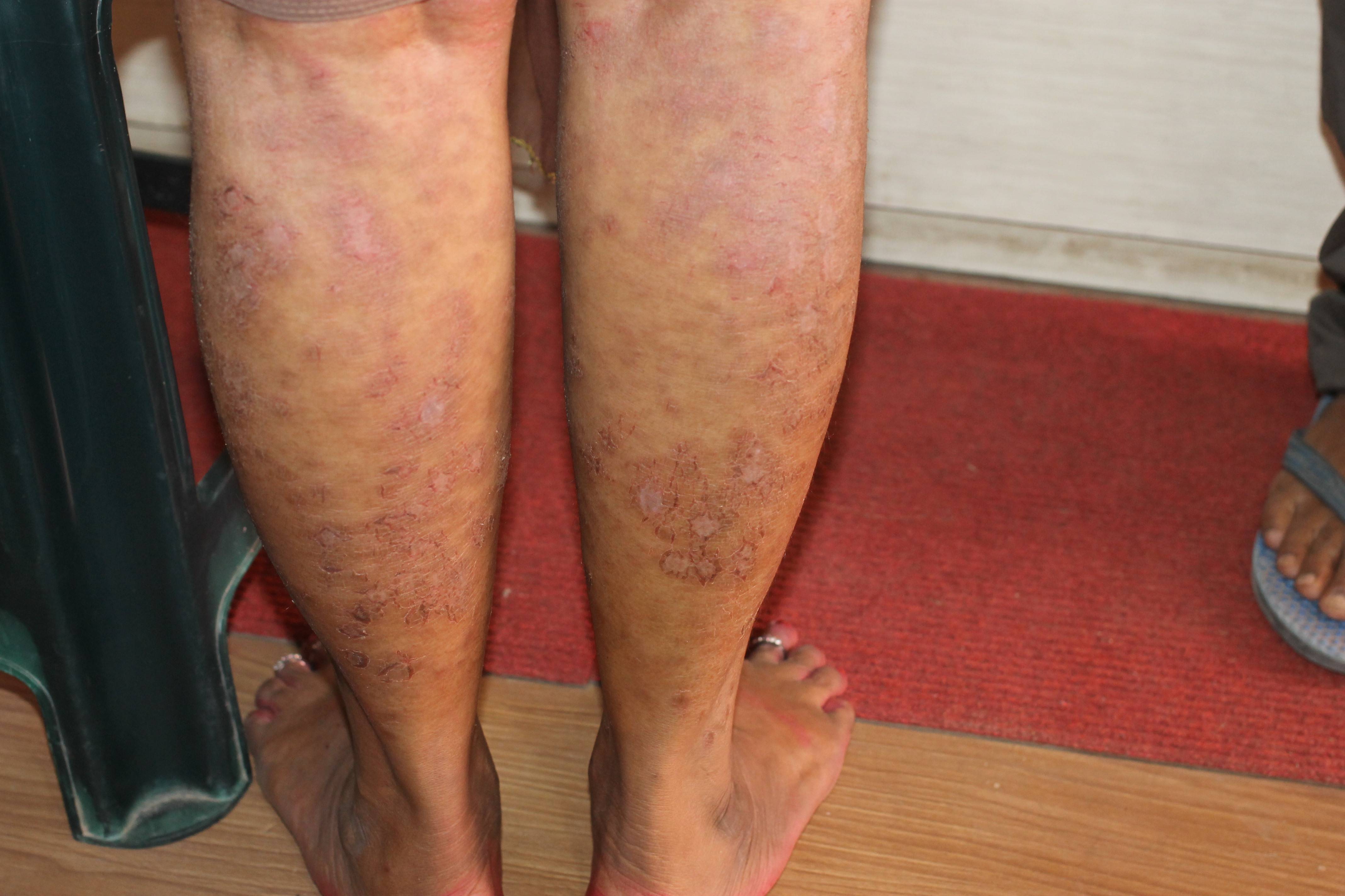 Successful treatment for Tinea Corporis with Homeopathy | Case Study