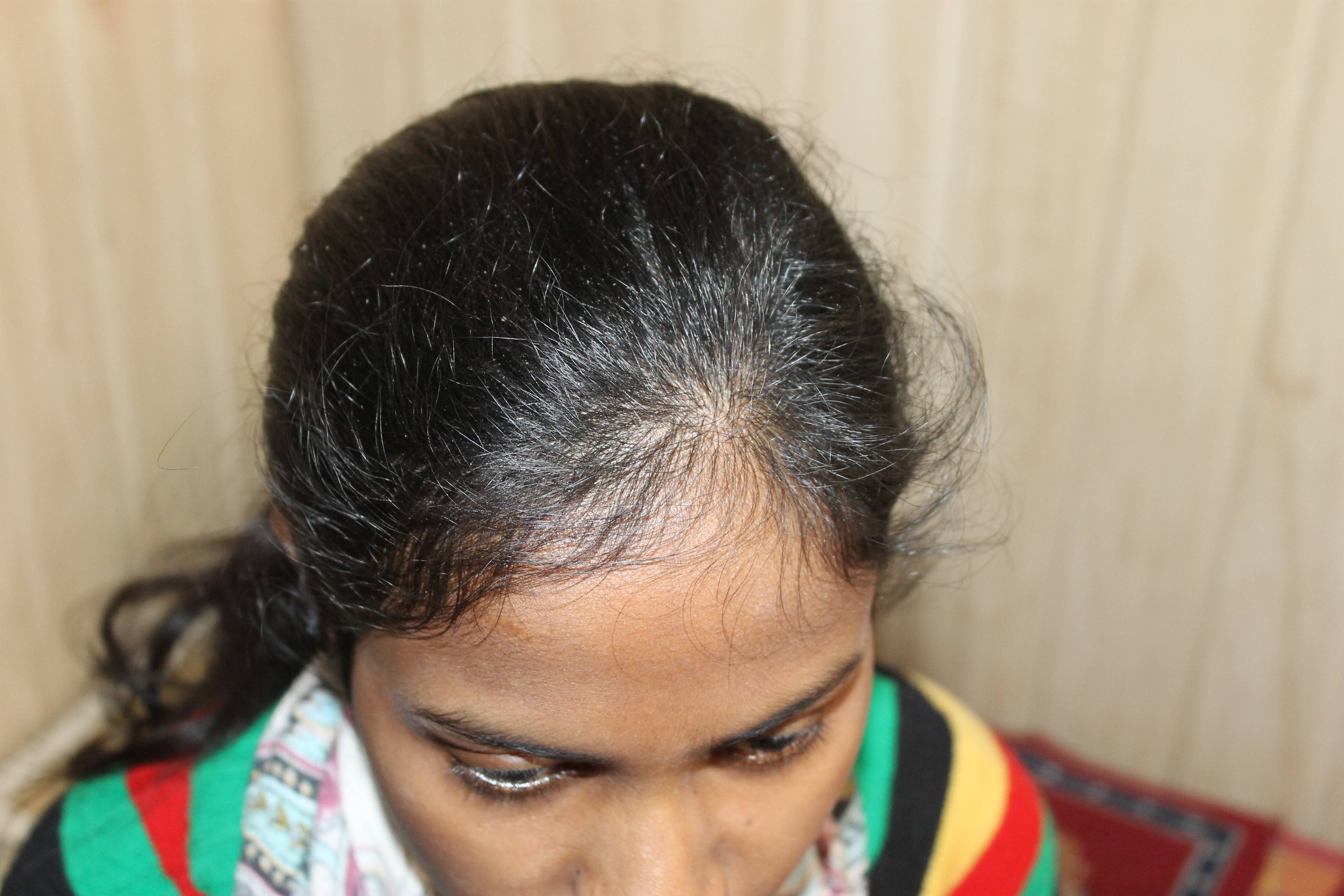 Hair Fall And Dandruff In A Young Girl Cured In Short Time Case Study