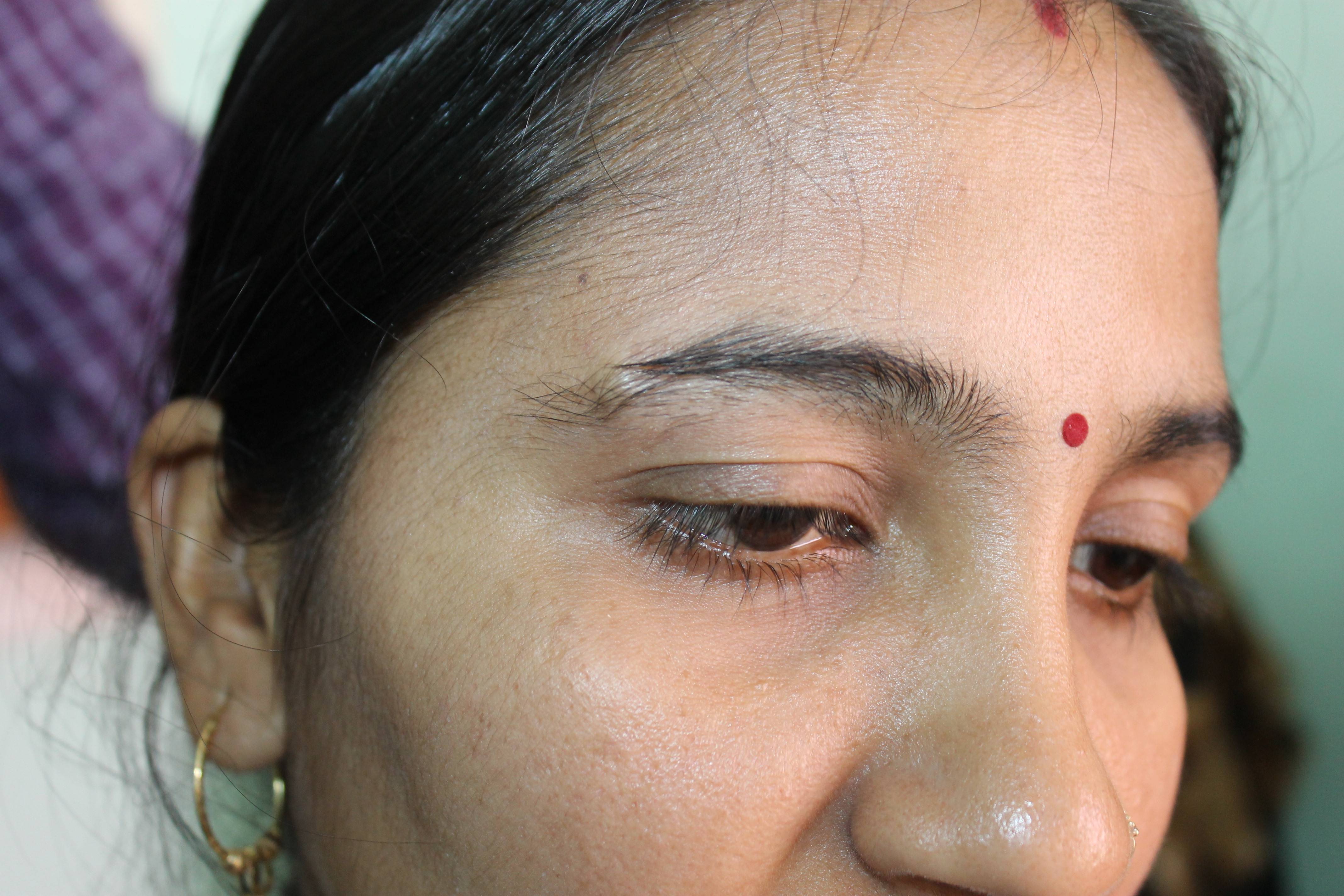 dermoid cyst on face