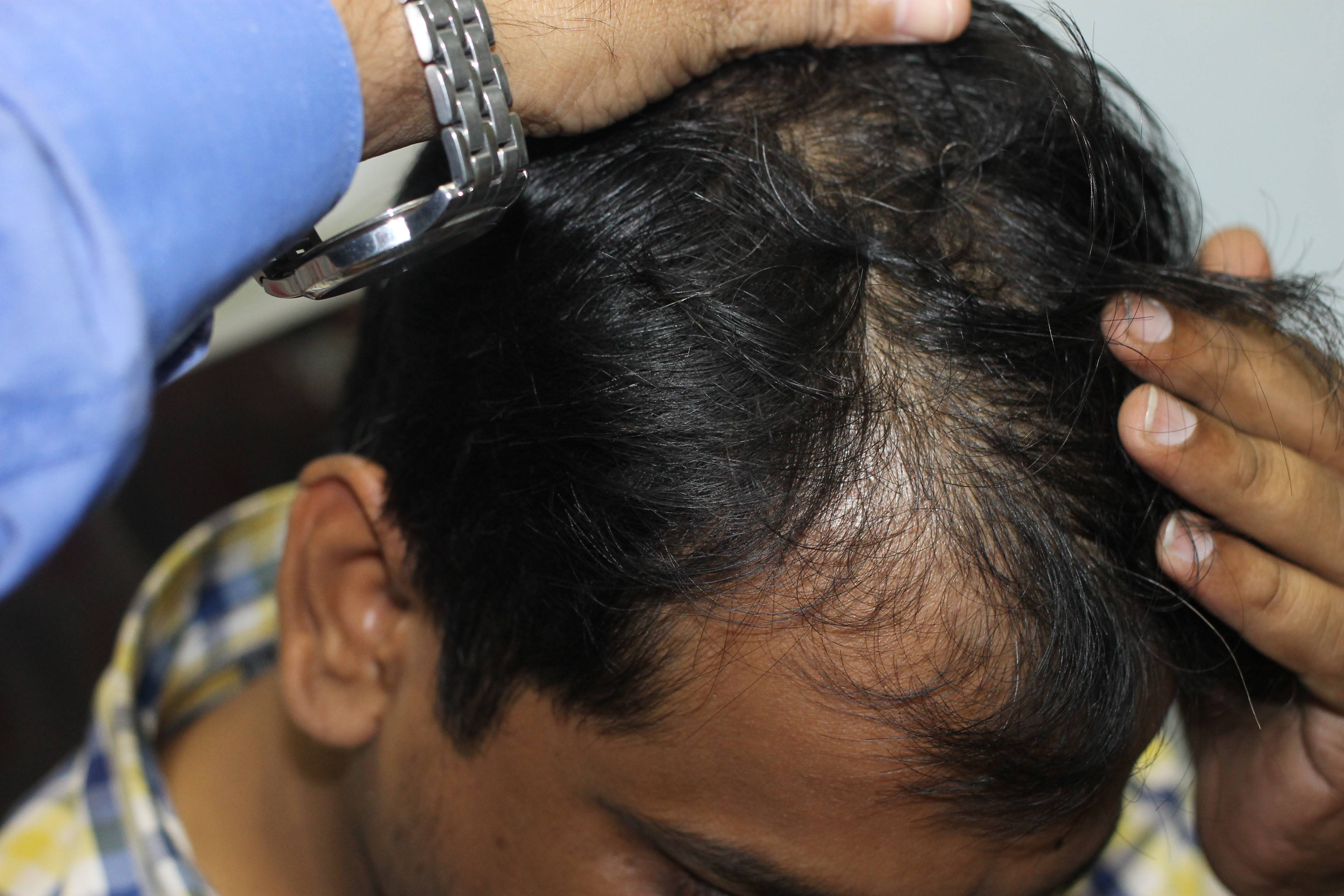 Visible Recovery in case of Seborrhoeic Dermatitis and hair fall with  homeopathy | Case Study