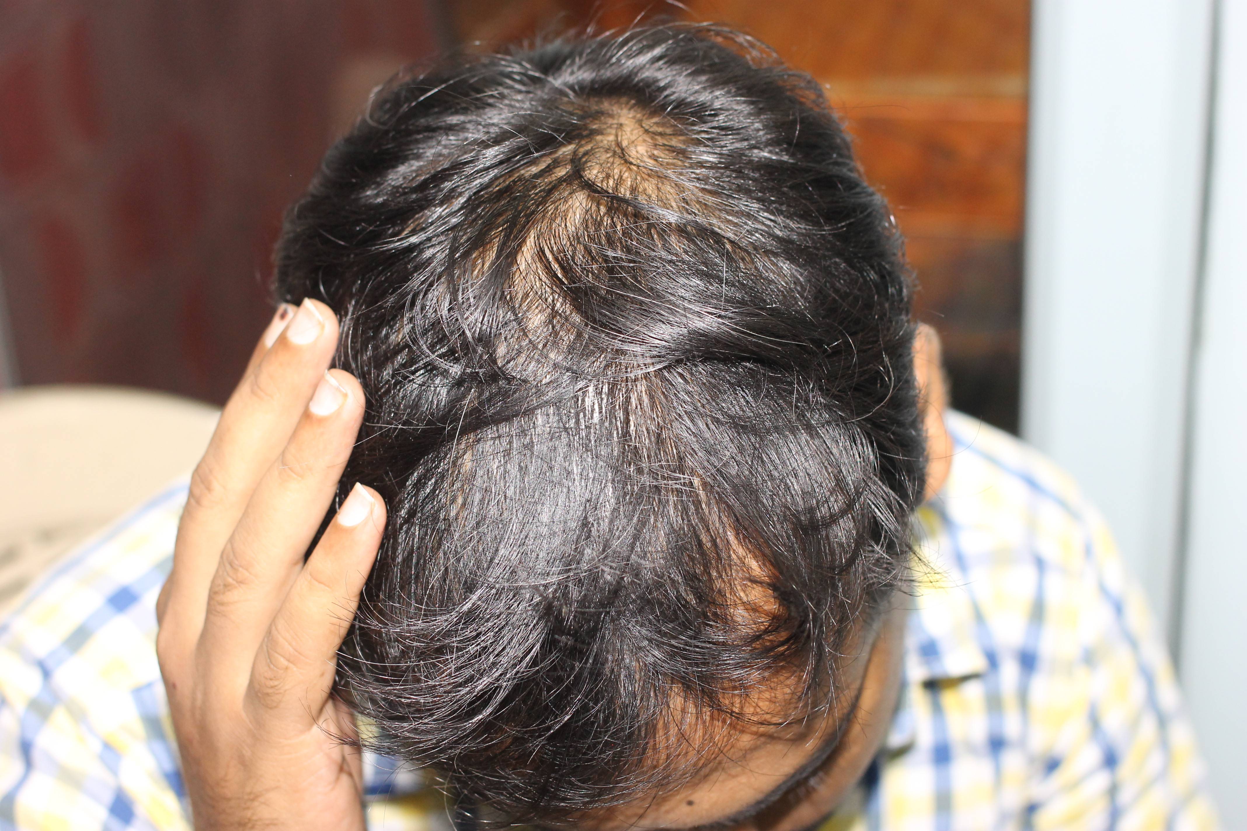 Visible Recovery in case of Seborrhoeic Dermatitis and hair fall with  homeopathy | Case Study
