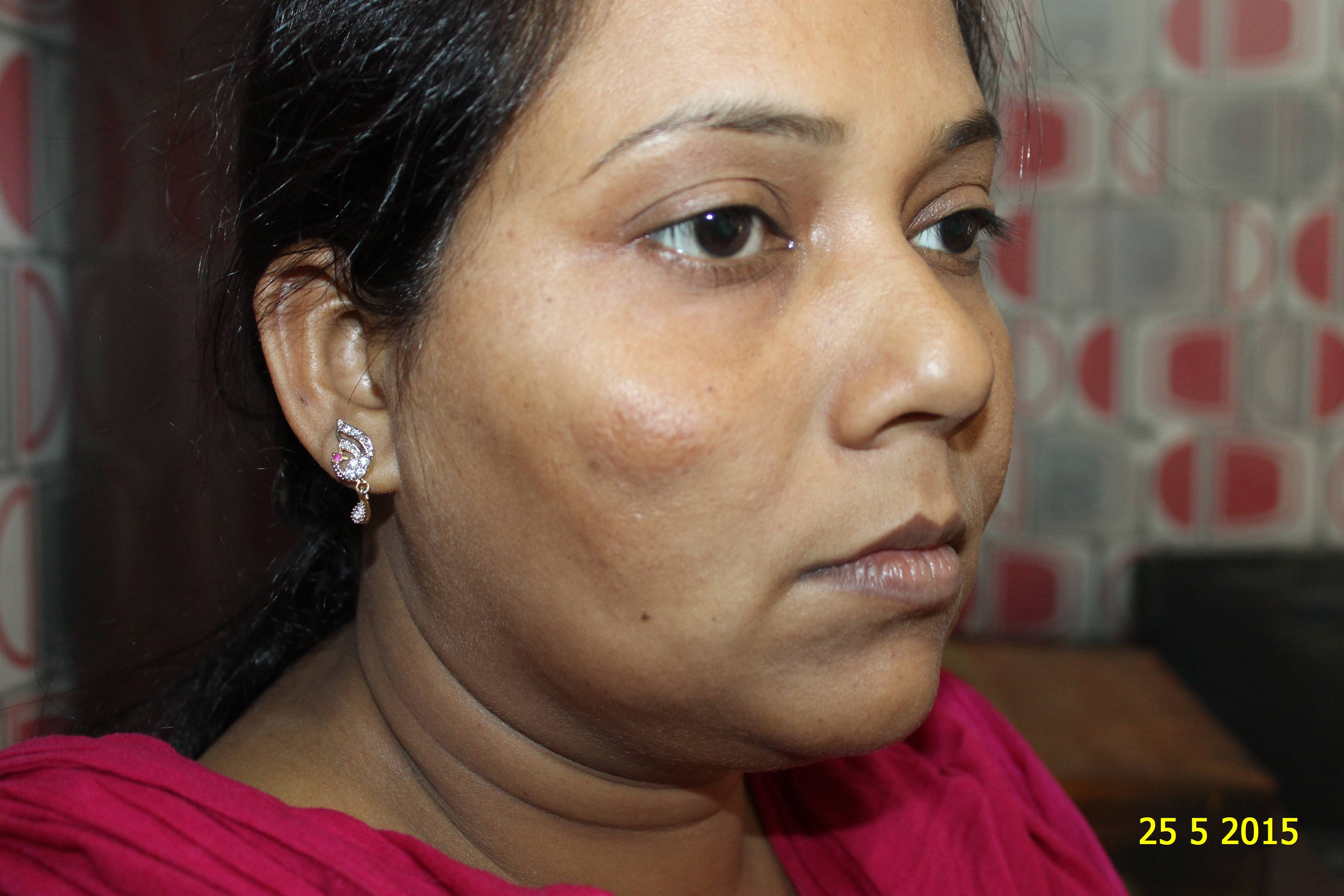 Remarkable recovery in case of Melasma (Chloasma) with homeopathy ...