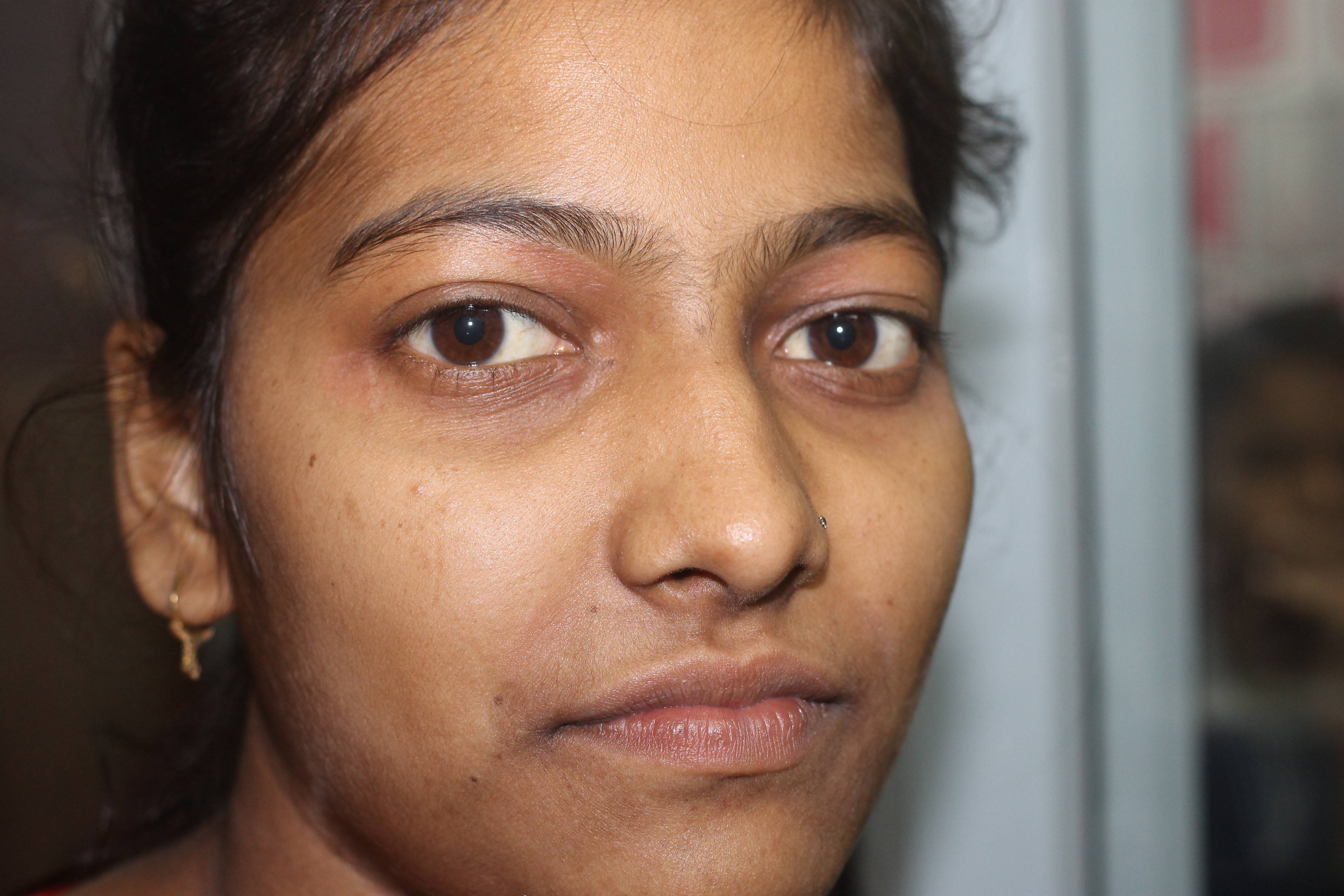 Air Born Contact Dermatitis( ABCD ) Cured with Homeopathy | Case Study