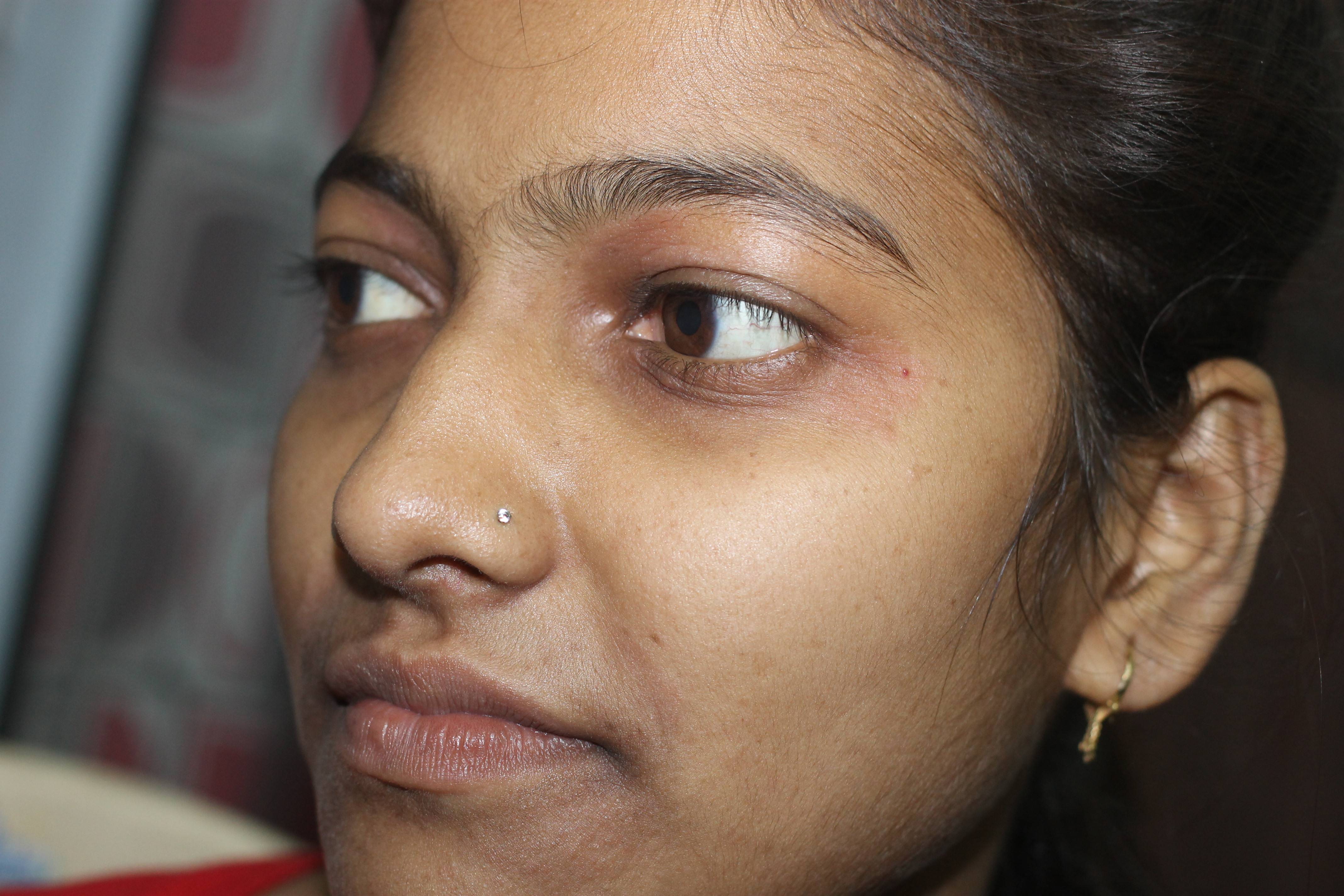 Air Born Contact Dermatitis( ABCD ) Cured with Homeopathy | Case Study