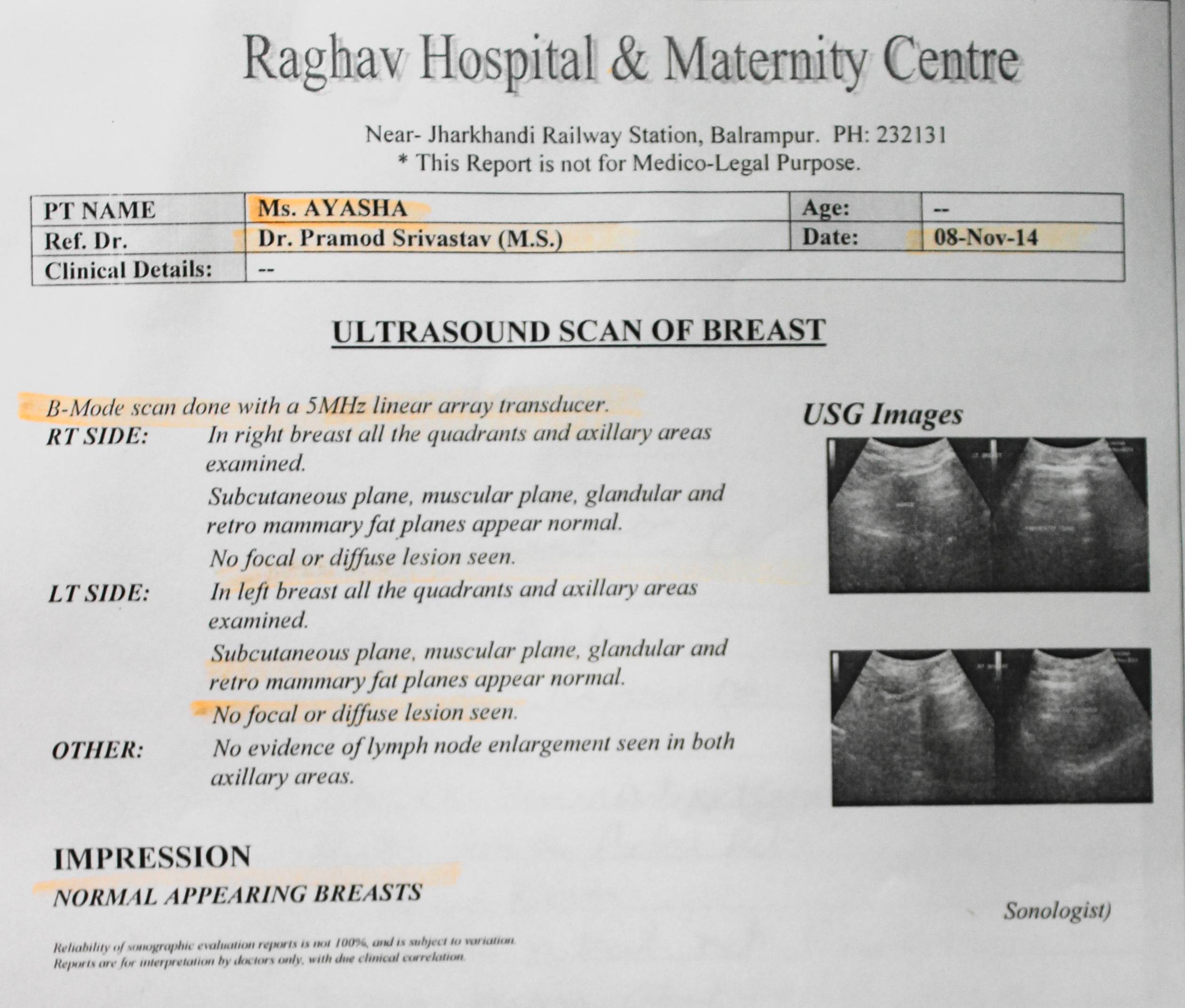 fibroadenoma-of-breast-cured-by-homeopathy-case-study