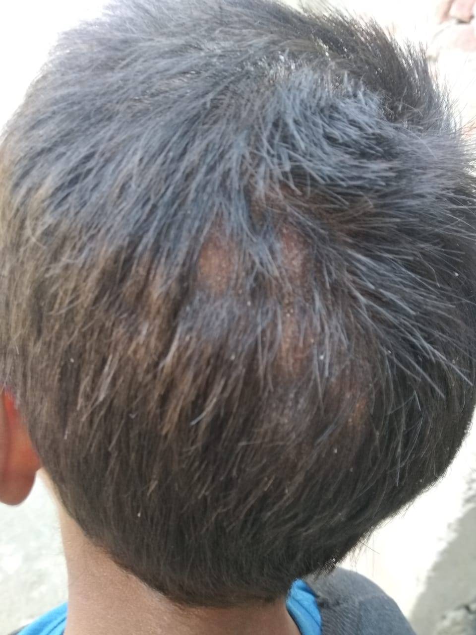Folliculitis of Scalp In Child Cured with homeopathy | Case Study
